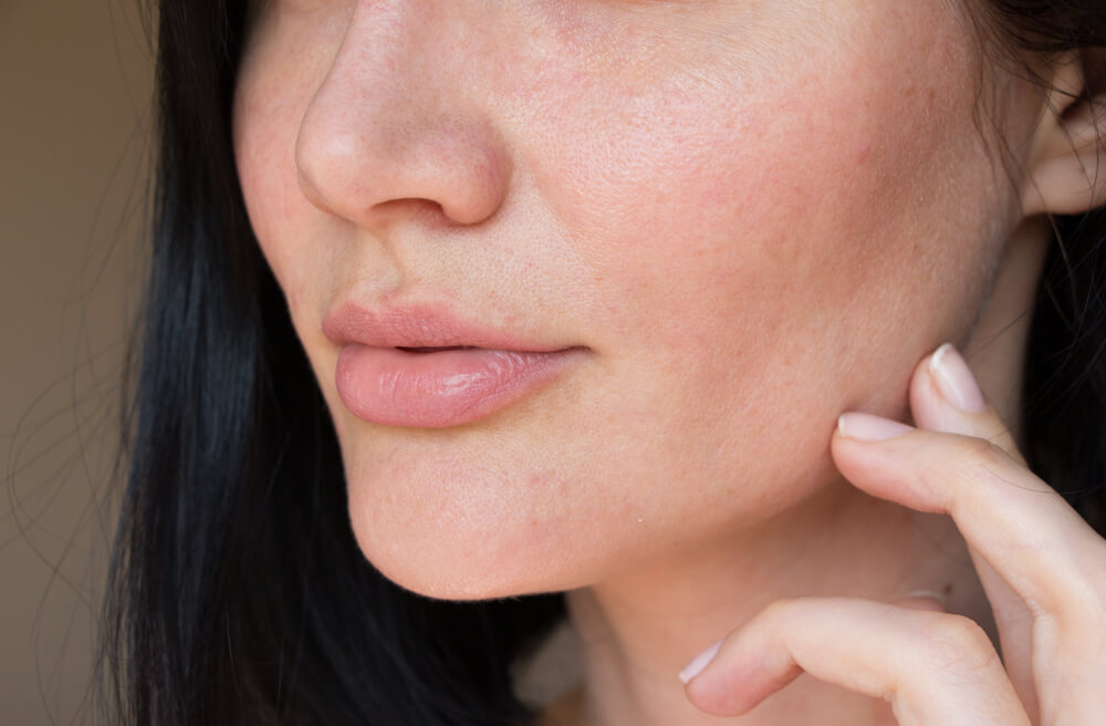 Skin after using Stem Cell Facial Peeling