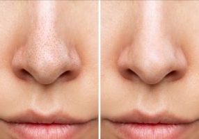 closeup of pores on face