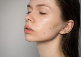 woman oily skin