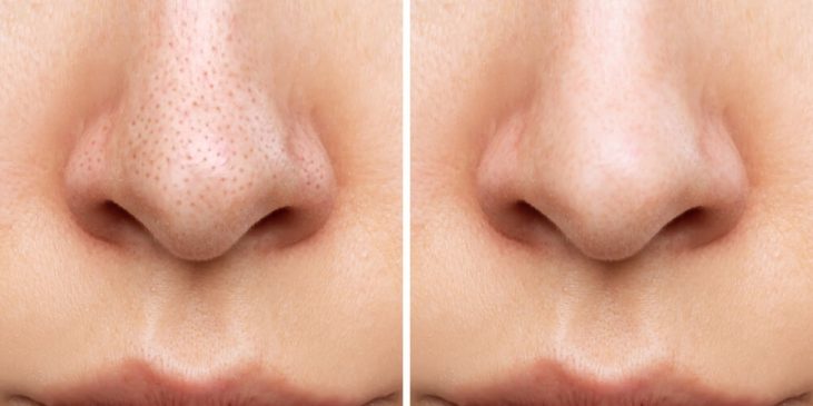 closeup of pores on face